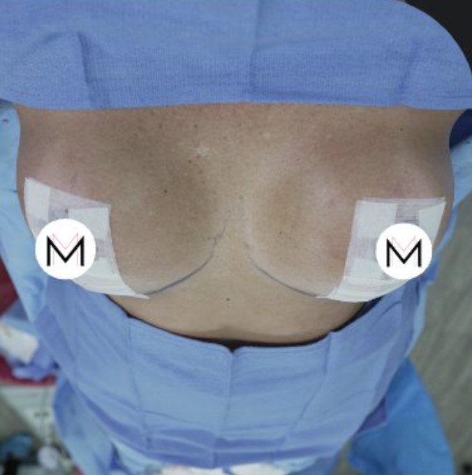 Breast Augmentation Surgery Before and After