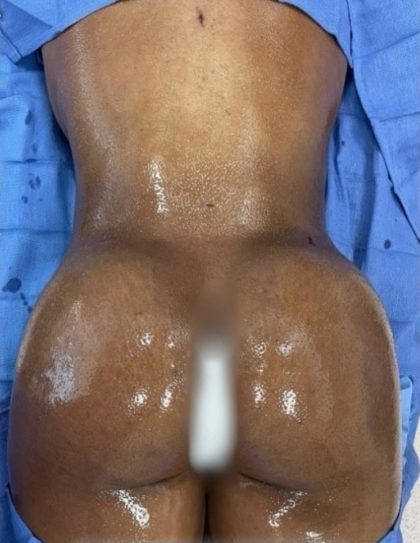 Brazilian Butt Lift Before & After Patient #849