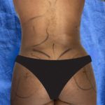 Brazilian Butt Lift Before & After Patient #850