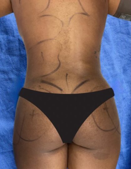 Brazilian Butt Lift Before & After Patient #850