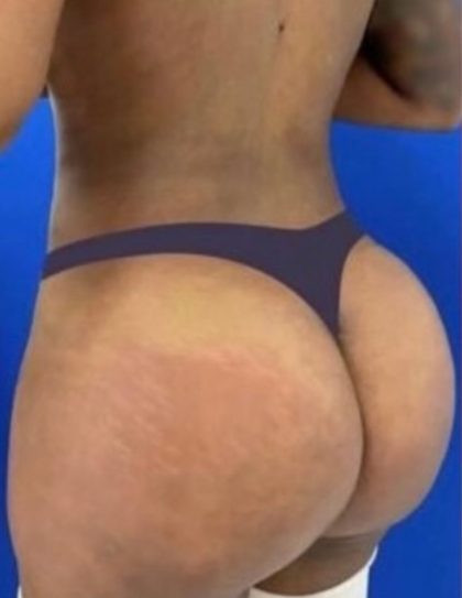 Brazilian Butt Lift Before & After Patient #833