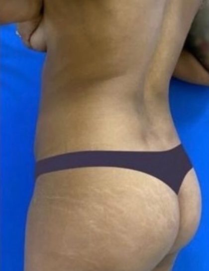 Brazilian Butt Lift Before & After Patient #833