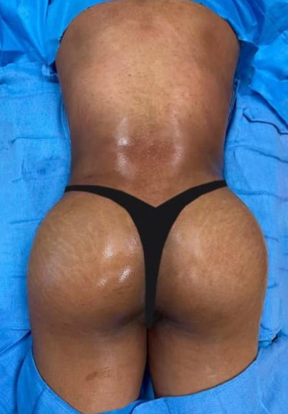 Brazilian Butt Lift Before & After Patient #852