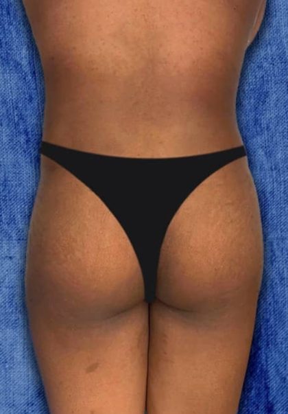 Brazilian Butt Lift Before & After Patient #852