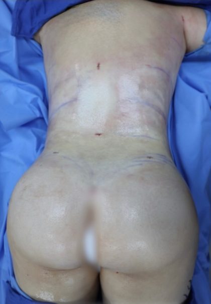 Brazilian Butt Lift Before & After Patient #851