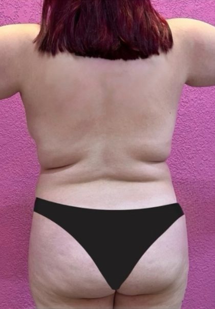 Brazilian Butt Lift Before & After Patient #851