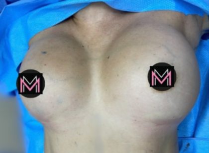 Breast Augmentation Before & After Patient #834