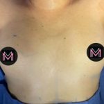 Breast Augmentation Before & After Patient #834