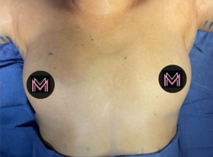 Breast Augmentation Before & After Patient #834