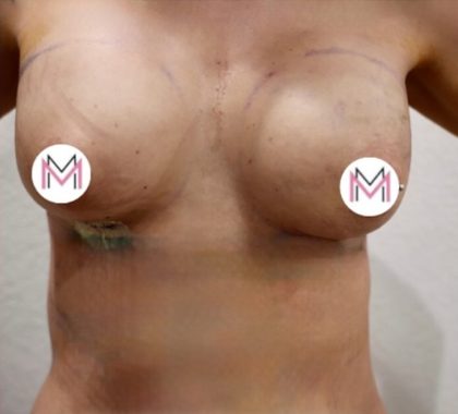 Breast Augmentation Before & After Patient #827