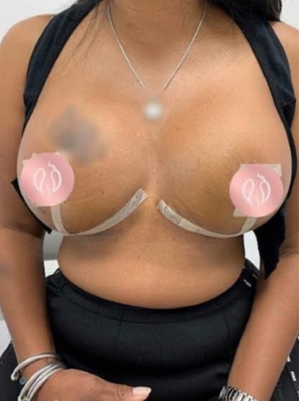 Breast Lift Before & After Patient #867