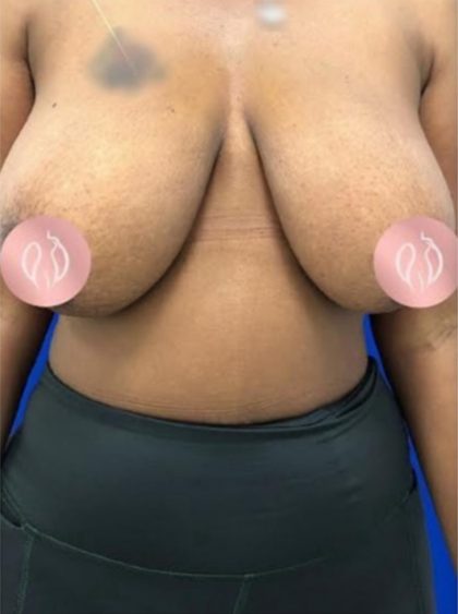 Breast Lift Before & After Patient #867