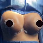 Breast Lift Before & After Patient #874