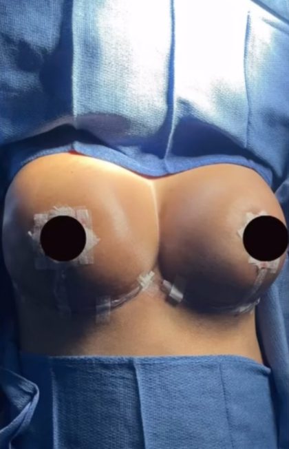 Breast Lift Before & After Patient #874