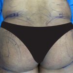 Brazilian Butt Lift Before & After Patient #825