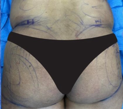 Brazilian Butt Lift Before & After Patient #825