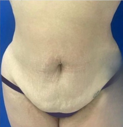 Liposuction 360 Before & After Patient #830