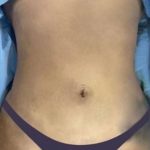 Liposuction 360 Before & After Patient #830