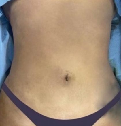 Liposuction 360 Before & After Patient #830